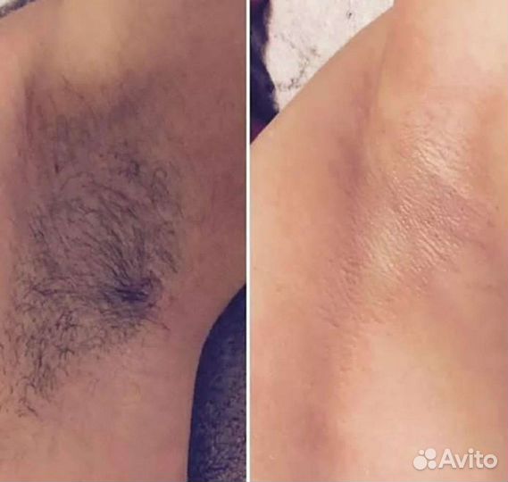 SPA-шугаринг/ваксинг