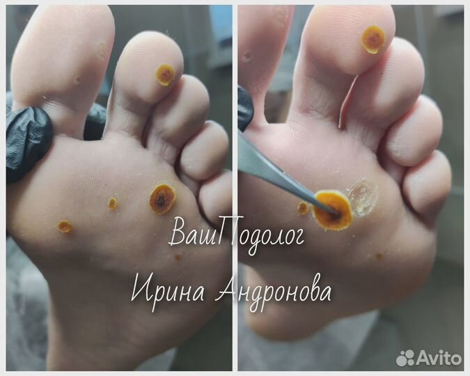 Подолог.Педикюр,вросший ноготь,трещины,мозоли