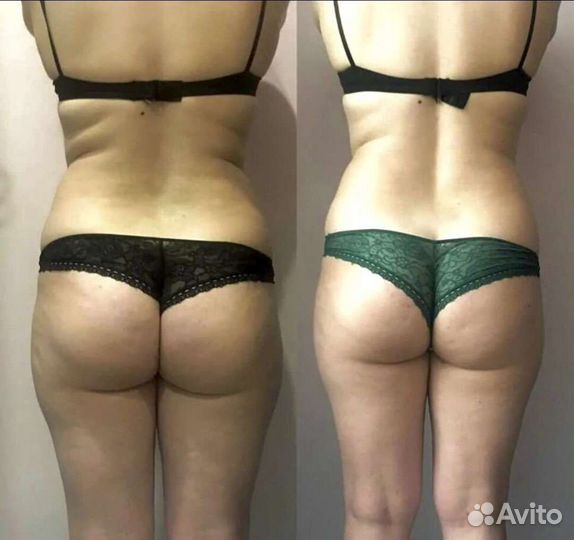 Кавитация горячий вакуум липолитики