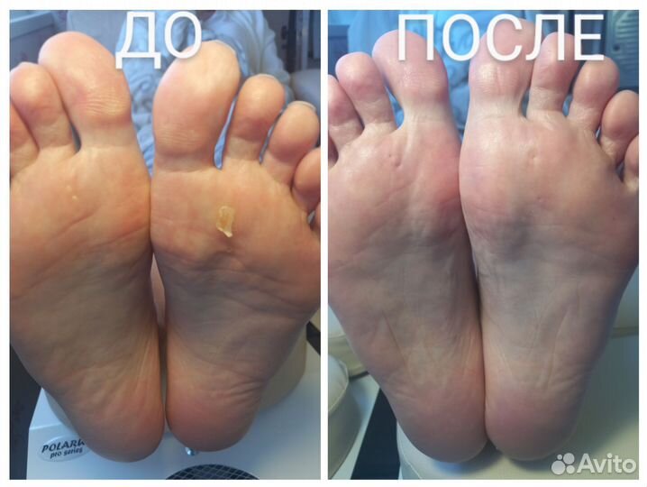 Полология. Ортониксия. Титановая нить