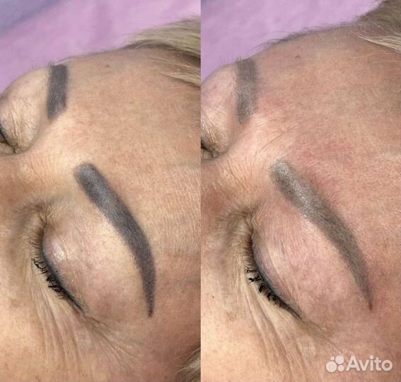 Удаление некачественного татуажа с ремовером