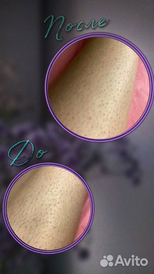 Шугаринг на дому