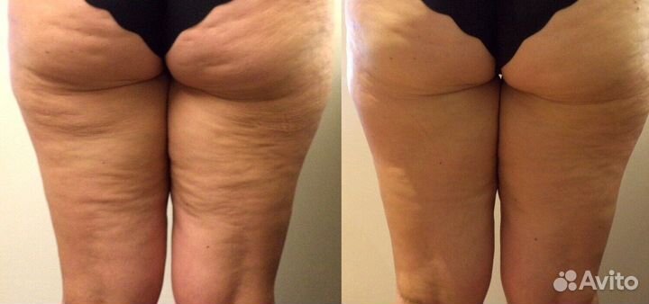 Лимфо дренажный массаж тела