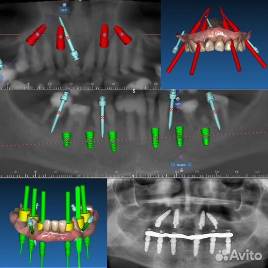 Хирургический шаблон RealGuide,BlueSkyPlan,ExoCad