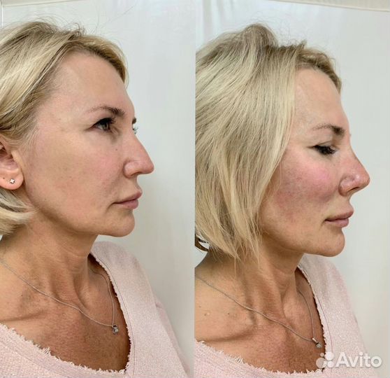 Full face омоложение
