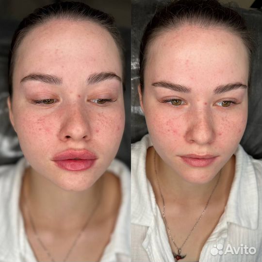 Full face омоложение