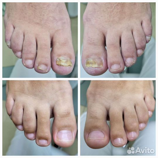 Коррекция вросшего ногтя