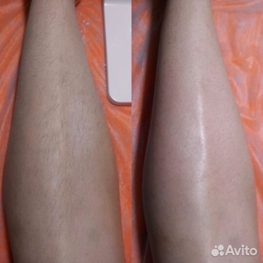 Спа-шугаринг