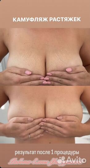 Камуфляж рубцов/растяжек/ареол