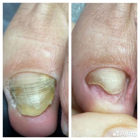 Лечебный педикюр,подолог