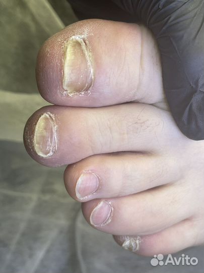 Педикюр подолог