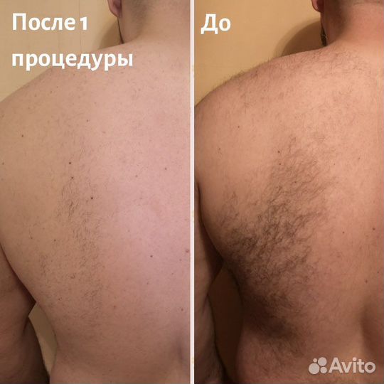 Электроэпиляция