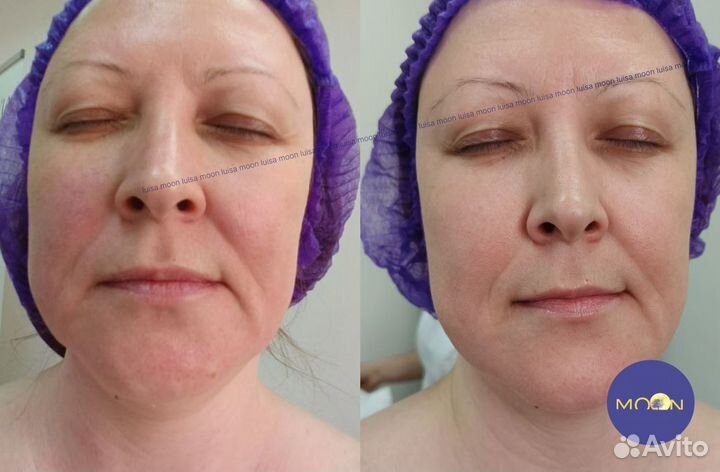 Массаж лица