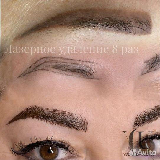 Лазерное удаление татуажа