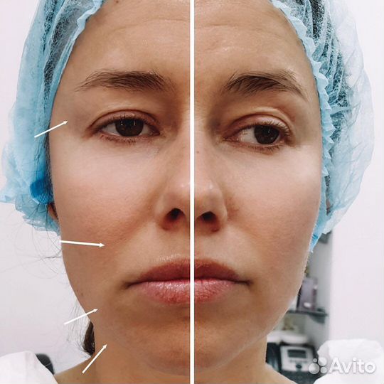 Косметолог. Увеличение губ. Ботокс для лица. Смас