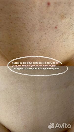 Лазерная эпиляция