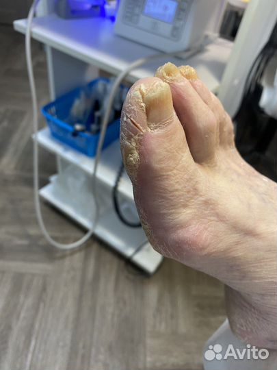 Педикюр подолог