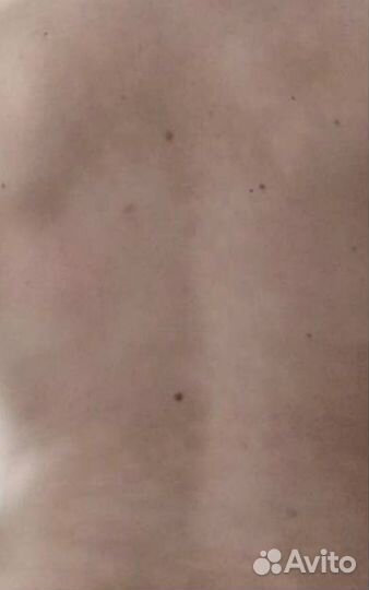 Мазь от псориаза