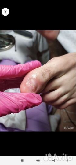 Медицинский педикюр подолог Медиц.Образ