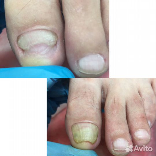 Педикюр аппаратный, основы подологии