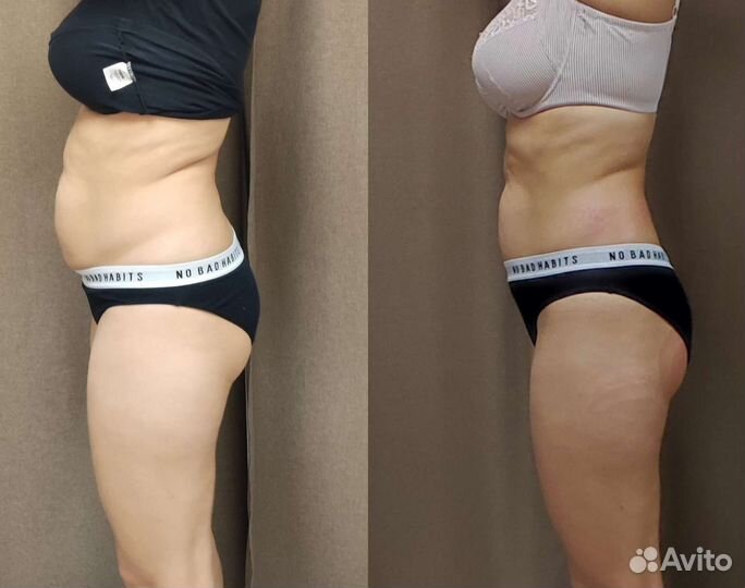 Модель на аппаратные методики коррекции фигуры