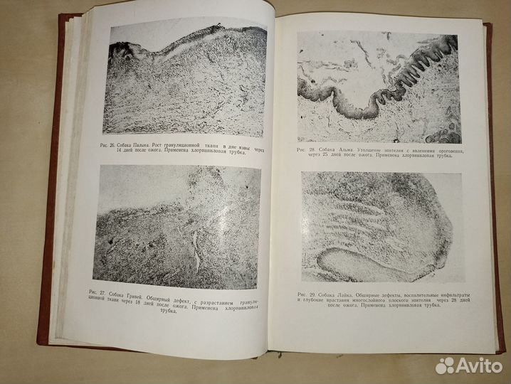 Лечение острых ожогов и стенозов пищевода.1961
