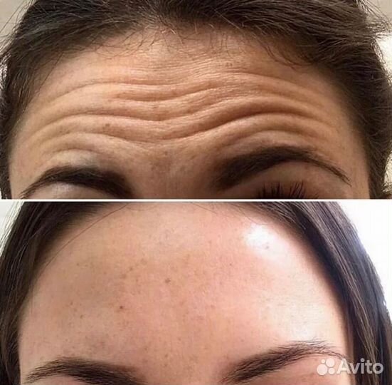Ботулинотерапия / ботокс лба и межбровки