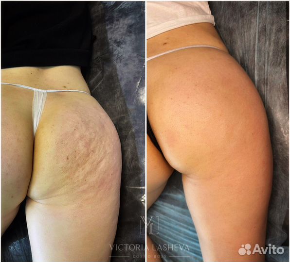 Аппаратный массаж тела