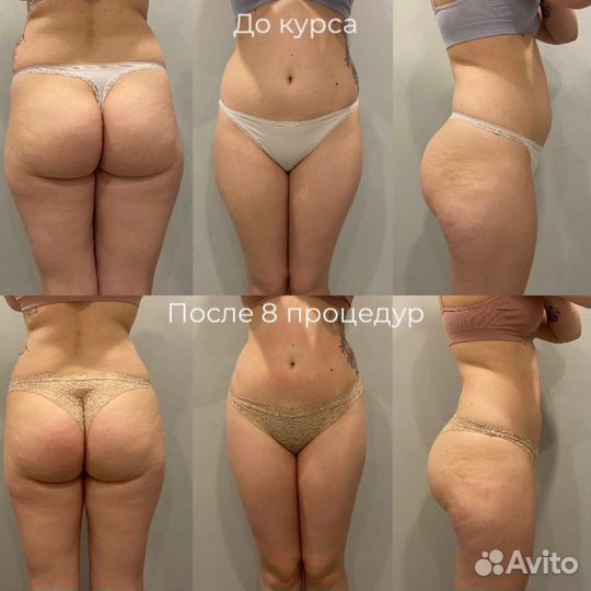 LPG массаж, RF лифтинг