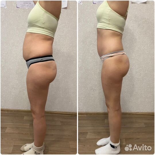 Массаж ручной и аппаратный LPG