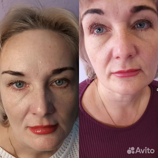 Ботокс для лица