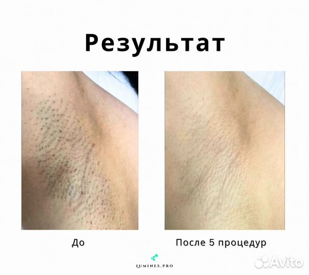 Аппарат для эпиляции Lumines Max’One 1200вт