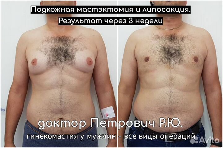 Лечение гинекомастии смешанной формы