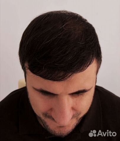 Пересадка волос без швов, рубцов и шрамов