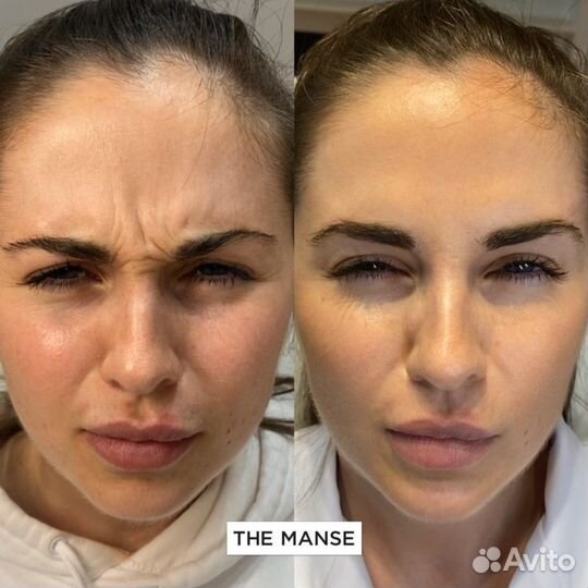 Ботокс,BroTox, Диспорт