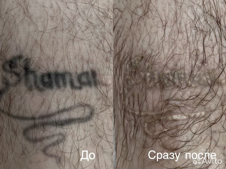 Лазерное удаление тату