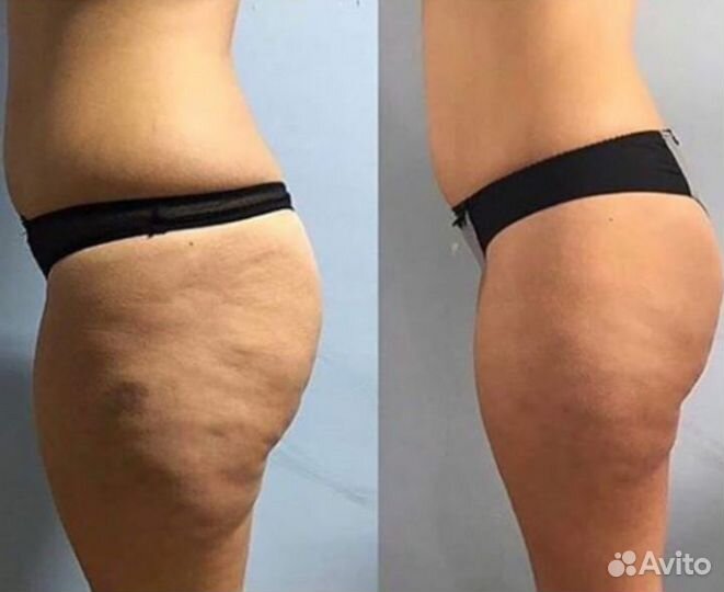 Эндосфера массаж