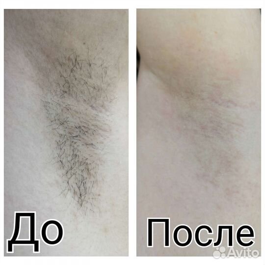 Шугаринг и брови