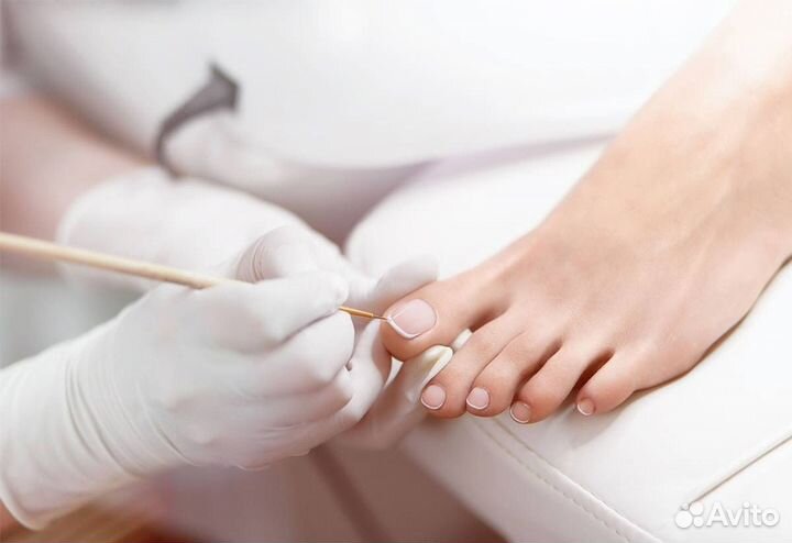 Лечение грибка ногтей