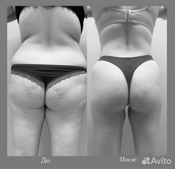 Криолиполиз