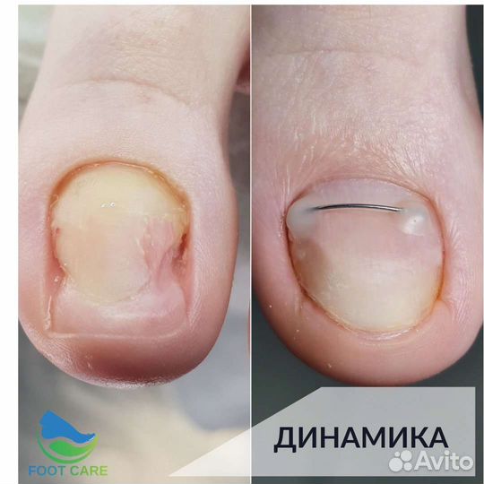 Подолог. Вросший ноготь / медицинский педикюр