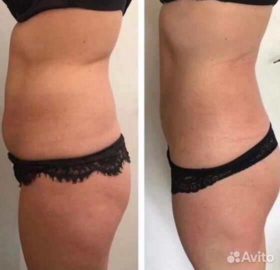 Криолиполиз, кавитация, прессотерапия, LPG, емс