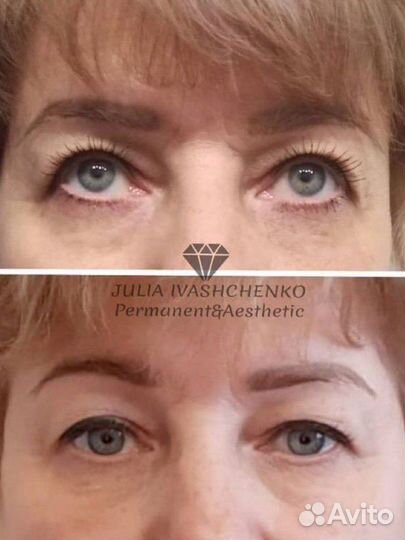 Омоложение