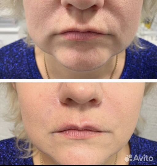 Косметолог нити губы ботокс лазер игольчатый РФ