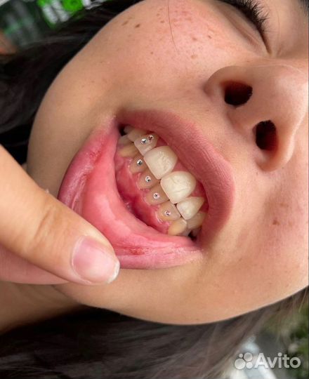 Скайсы стразы на зубы