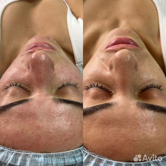 Плазмолифтинг