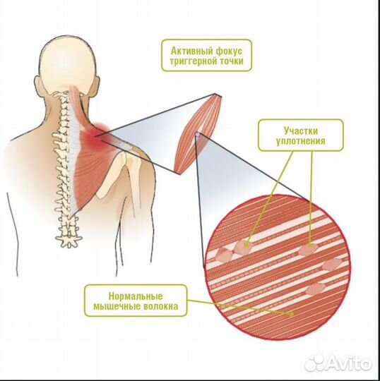 Миопрессура. Акупрессура. Миофасциальная терапия