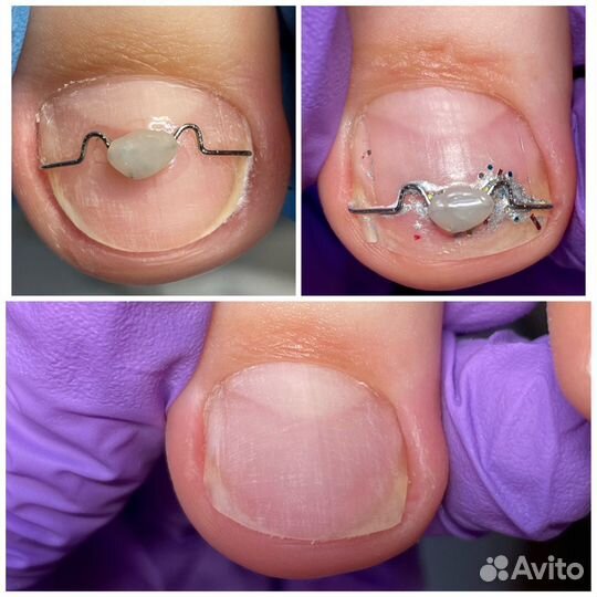 Мед. педикюр. Титановая нить. Подолог