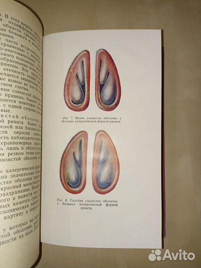 Вазомоторный ринит. Дайняк. 1966