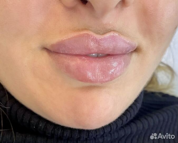 Увеличение губ контурная пластика